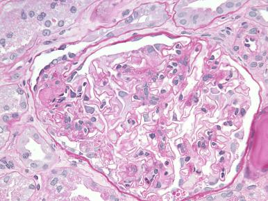 Figure 23.8, Tip variant of focal segmental glomerulosclerosis shows Bowman capsular adhesion and hyaline insudation at the tubular pole. The adjacent podocytes also show hypertrophy with cytoplasmic protein droplets (PAS).