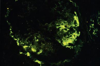 Figure 23.9, Immunofluorescence microscopy demonstrating segmental deposition of IgM in a biopsy from a patient with focal and segmental glomerulosclerosis (anti-IgM).