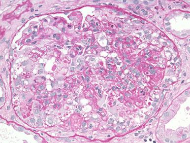 Figure 23.10, Collapsing variant of focal segmental glomerulosclerosis lesion is characterized by the retracted glomerular basement membrane and hyperplastic overlying podocytes obliterating the Bowman space. The podocytes have prominent cytoplasm protein droplets (PAS).