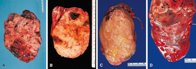 Figure 24.1, Various Gross Appearances of Wilms Tumor.