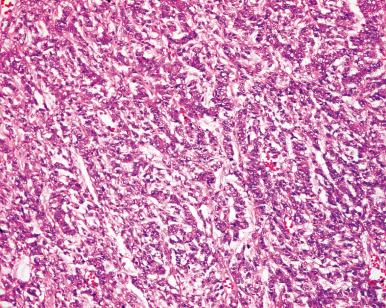 Figure 24.11, Clear cell sarcoma of kidney, trabecular pattern of growth.