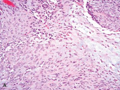 Figure 24.12, Clear Cell Sarcoma of Kidney.