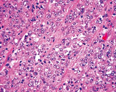 Figure 24.14, Rhabdoid Tumor of Kidney.