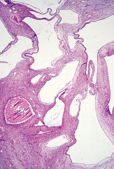 Figure 24.16, Low-power microscopic appearance of pediatric cystic nephroma showing multiple cysts lined by flattened epithelium and separated by a cellular spindle cell stroma.