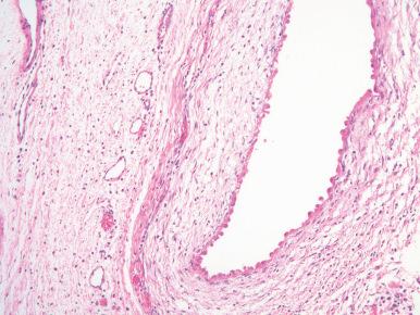 Figure 24.17, Pediatric Cystic Nephroma.