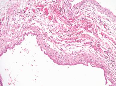 Figure 24.18, Pediatric Cystic Nephroma.