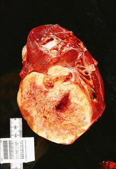 Figure 24.19, Gross appearance of Ewing sarcoma, primary in the kidney.