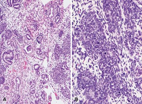 Figure 24.2, Microscopic Appearance of Wilms Tumor.