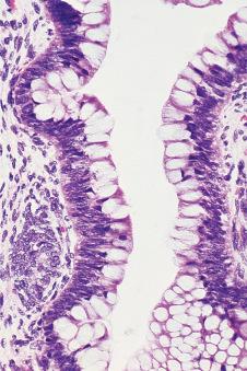 Figure 24.3, Mucinous epithelium in Wilms tumor.