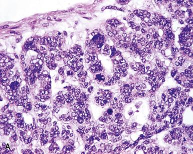 Figure 24.4, Anaplastic (“Unfavorable Histology”) Wilms Tumor.