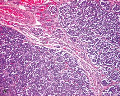 Figure 24.5, Nephrogenic rests. Perilobar (A) and intralobar (B) types.