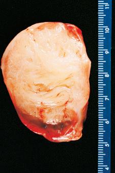 Figure 24.6, Congenital Mesoblastic Nephroma.