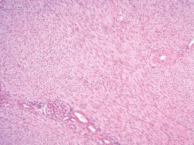 Figure 24.7, Congenital Mesoblastic Nephroma, Classic Type.