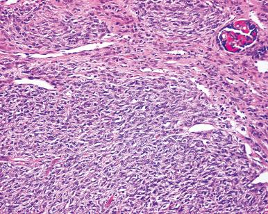 Figure 24.8, Congenital Mesoblastic Nephroma, Cellular Type, Accompanied by Mitotic Activity.