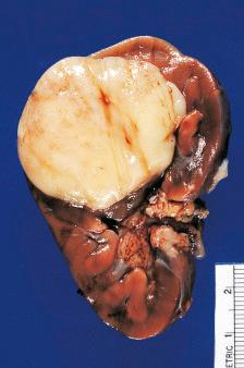 Figure 24.9, Gross Appearance of Clear Cell Sarcoma of Kidney.