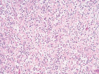 Figure 24.10, Clear cell sarcoma of kidney, prototypical appearance.