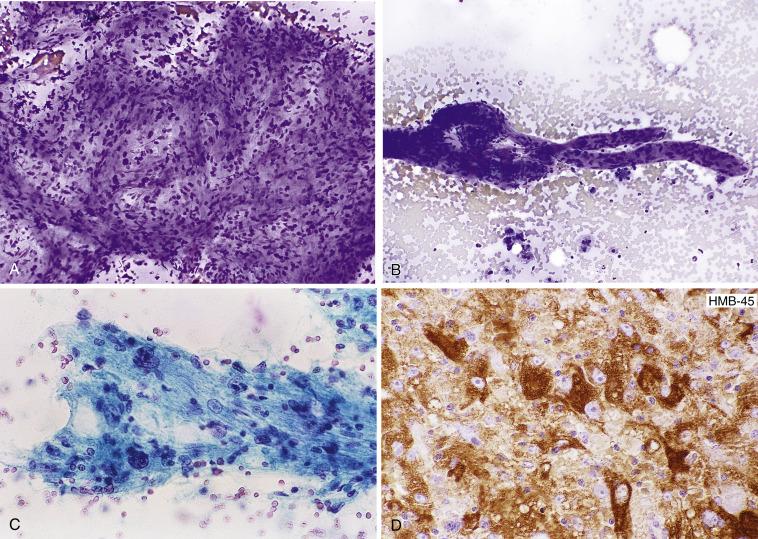 Fig. 15.5, Angiomyolipoma.