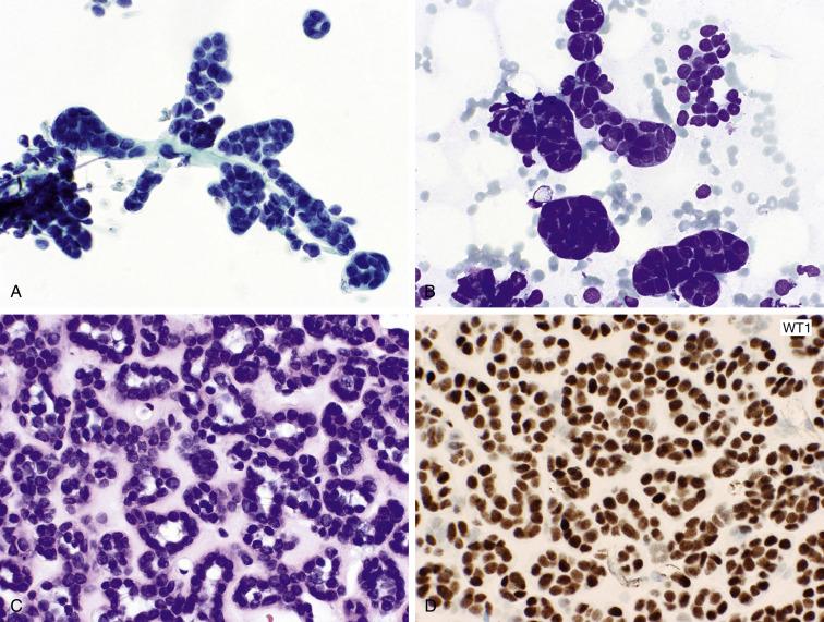 Fig. 15.6, Metanephric Adenoma.