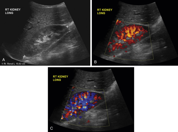 Fig. 19.3, Normal kidney with power and color Doppler. (A) Right renal ultrasound demonstrating normal appearance of the kidney. Liver is anterior. (B) With power Doppler, there is perfusion of the kidney to the renal cortex using the appropriate Doppler settings. (C) With color Doppler ultrasound, there is perfusion of the kidney to the renal cortex.