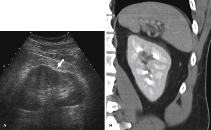 Fig. 19.4, Dromedary hump. (A) Ultrasound of the left kidney demonstrates masslike prominence of the midpole of the left kidney ( arrow ), thought to be caused by compression of the spleen on the upper pole of the left kidney. This was thought to be a mass, and a CT scan was obtained. (B) Corresponding CT scan showing prominence of the midpole of the left kidney, but without a mass.