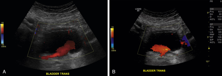 Fig. 19.5, Normal bladder jets. (A) Transverse ultrasound through the bladder demonstrating the right ureteral jet. (B) Transverse ultrasound through the bladder demonstrating the left ureteral jet.