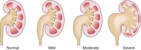 Fig. 19.6, Hydronephrosis. Hydronephrosis can be mild, moderate, or severe. In mild hydronephrosis, there are enlarged calyces. In moderate hydronephrosis, there are dilated calyces with obliteration of the papillae and blunted pyramids. In more severe hydronephrosis, there is marked calyceal dilatation, complete obliteration of the papillae and pyramids, and thinning of the renal cortex.