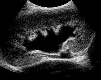 Fig. 19.7, Moderate hydronephrosis. Renal ultrasound dilation demonstrating moderate hydronephrosis with blunting of the calyceal system and more pronounced renal pelvis dilation.