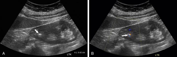 Fig. 19.9, Renal stone plus “twinkle” artifact. (A) This 4-mm stone is well demonstrated by ultrasound calipers ( arrow ), with little shadowing. (B) With color Doppler ultrasound, there is evidence of a “twinkle” artifact at and distal to the stone.