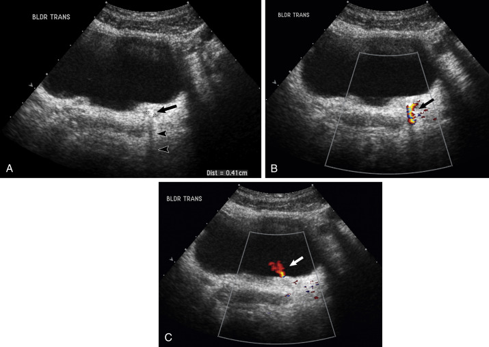 Fig. 19.10, Distal ureterovesicular stone. (A) Transverse ultrasound through the bladder demonstrates a small echogenic focus of a stone lodged in the distal ureter at the ureterovesicular junction ( arrow ). Note the distal acoustic shadowing ( arrowheads ). The stone did not move with patient positioning. (B) With color Doppler, the stone is more evident, showing a “twinkle” artifact distal to the stone ( arrow ). (C) Color Doppler of the ureteric orifice demonstrates flow through the ureter, indicating the stone causes partial and not complete ureteral obstruction.