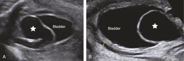 • Fig. 33.11, Typical ultrasound appearance of a ureterocele: a cystic structure (star) in the bladder, which is the dilated, intravesical part of the ureter (arrow) .