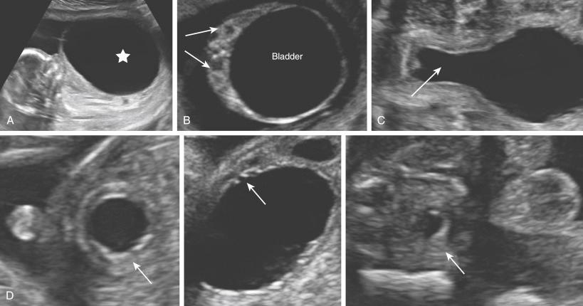 • Fig. 33.12, Typical ultrasound appearance of severe lower urinary tract obstruction: megacystis (star) ( A ), bilateral hydronephrosis and signs of renal dysplasia (arrows) ( B ), dilated proximal urethra or ‘keyhole’ sign ( C ). Signs of bladder wall hypertrophy and trabeculation are shown in D (arrows) .