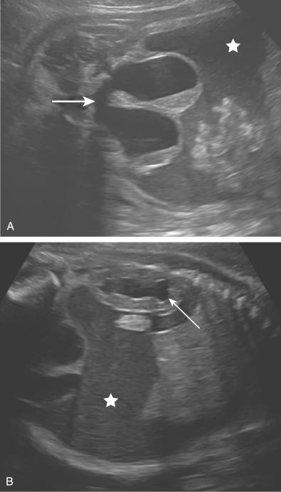 • Fig. 33.14, A and B, Cloacal malformations. Dilated uterus with uterine septum (large arrow) , urinary ascites (stars) and hydronephrosis (arrow) in a fetus with a persistent cloaca.