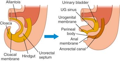 • Fig. 33.2, Division of the cloaca into the urogenital (UG) sinus and the rectum by ingrowth of the urorectal septum. The UG sinus develops into bladder and proximal urethra.