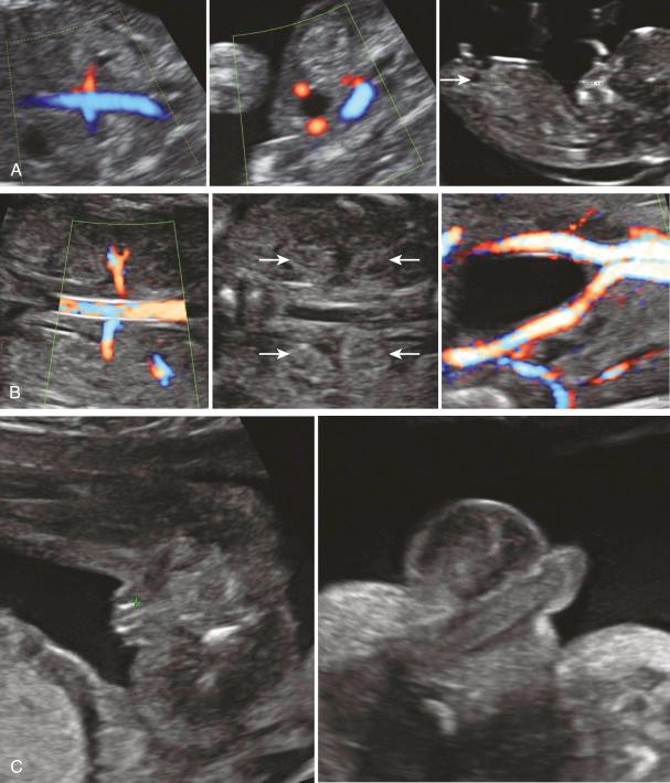 • Fig. 33.4, Ultrasound appearance of the kidneys and fetal bladder in the first ( A ) and second ( B ) trimesters of pregnancy. Normal female and male external genitalia at 20 weeks of pregnancy ( C ).