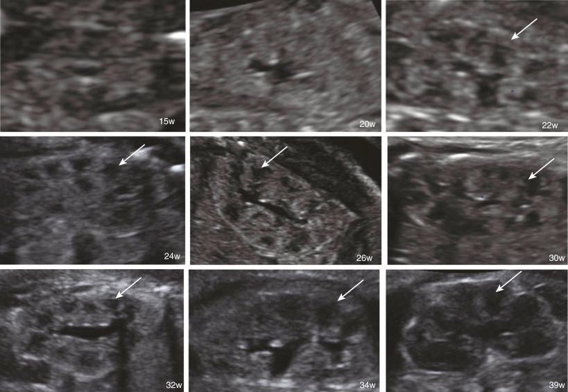 • Fig. 33.5, The normal corticomedullary differentiation throughout pregnancy. With advancing gestational age, the differentiation between the renal cortex and medulla becomes clearer. The medulla becomes hypoechogenic because of the appearance of the medullary pyramids (arrows) .