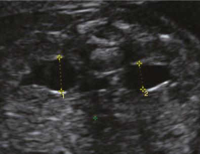 • Fig. 33.6, Measurement of the anteroposterior diameter of the renal pelvis.