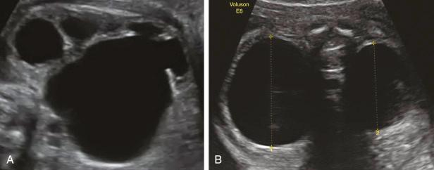 • Fig. 33.8, Severe hydronephrosis in uni- and bilateral ureteropelvic junction stenosis.