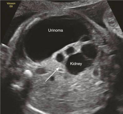 • Fig. 33.9, Severe ureteropelvic junction stenosis with leakage of urine into the retroperitoneal space: perirenal urinoma. Arrow indicates anteriorly displaced, hydronephrotic kidney.