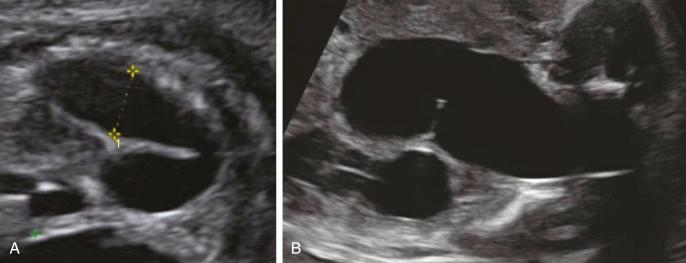 • Fig. 33.10, Ultrasound appearance of hydroureter ( A ) and megaureter ( B ).