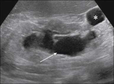 Fig. 37.1, Ultrasound image from a patient with acute myeloid leukemia, with acute kidney injury from obstruction. White arrow is pointing to severe hydronephrosis. White asterisk is within a benign kidney cyst.