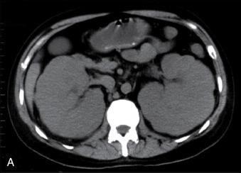 Fig. 37.2, A patient with chronic myeloid leukemia. A. Computed tomography showing bilateral enlargement of kidneys. B. Urine sediment under light microscopy at 160 ×, showing a white blood cell cast.