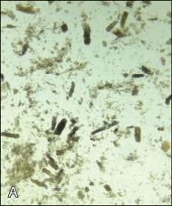 Fig. 37.3, Acute tubular necrosis in a patient with acute kidney injury from severe volume depletion and hypotension in the setting of chronic lymphocytic leukemia. A. 16× light microscopy showing many dense granular casts. B. 40× specimen from a kidney biopsy (stained with hematoxylin and eosin), showing dilated renal tubules, renal tubular cell cytoplasmic vacuolization, and nuclear dropout.