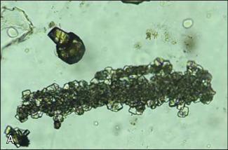 Fig. 37.4, Urine sediment from a patient with tumor lysis syndrome and hyperuricemia. A. 160× light microscopy showing urate crystal cast. B. 160× light microscopy with polarization showing birefringence of urate crystal cast. C. 40× light microscopy showing urate crystals and granular casts urate crystals. D. 40× light microscopy with polarization demonstrating birefringence of urate crystals.