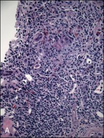 Fig. 37.5, Kidney biopsy from a patient with chronic lymphocytic leukemia and acute kidney injury. A. 160× light microscopy image of kidney biopsy specimen (stained with hematoxylin and eosin) showing extensive interstitial inflammation and renal tubule compression. B. 160× light microscopy image of kidney biopsy specimen (stained with anti-CD3 T-cell marker) showing a significant infiltrate of CD3 positive T-cells.