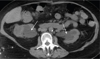 Fig. 38.1, A computed tomography scan from a patient with non-Hodgkin lymphoma with significant retroperitoneal lymph node involvement causing bilateral ureteral compression. The kidneys show severe hydronephrosis. The white arrows are pointing to severely dilated collecting system.