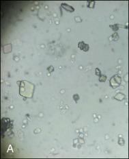 Fig. 38.3, Urine sediment from a patient with tumor lysis syndrome and hyperuricemia. A. 160× light microscopy showing urate crystals and white blood cells. B. 160× light microscopy with polarization demonstrating birefringence of urate crystals.