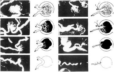 Figure 49.1., Stages of progressive vascular simplification and glomerular degeneration of cortical and juxtamedullary glomeruli and arterioles with associated microangiograms.