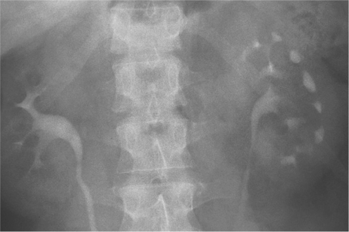 Left megacalycosis with numerous calyces showing poorly developed flattened papillae. †