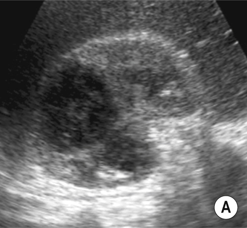 Renal abscess. (A) Ultrasound shows a hypoechoic right renal lesion with internal echoes. (B) Axial T1-weighted MRI shows a hypointense parenchymal lesion. (C) Axial T2-weighted MRI demonstrates hyperintensity relative to the surrounding renal parenchyma with a thick margin. (D) There is marginal enhancement on Gd-enhanced GRE T1-weighted axial image. **