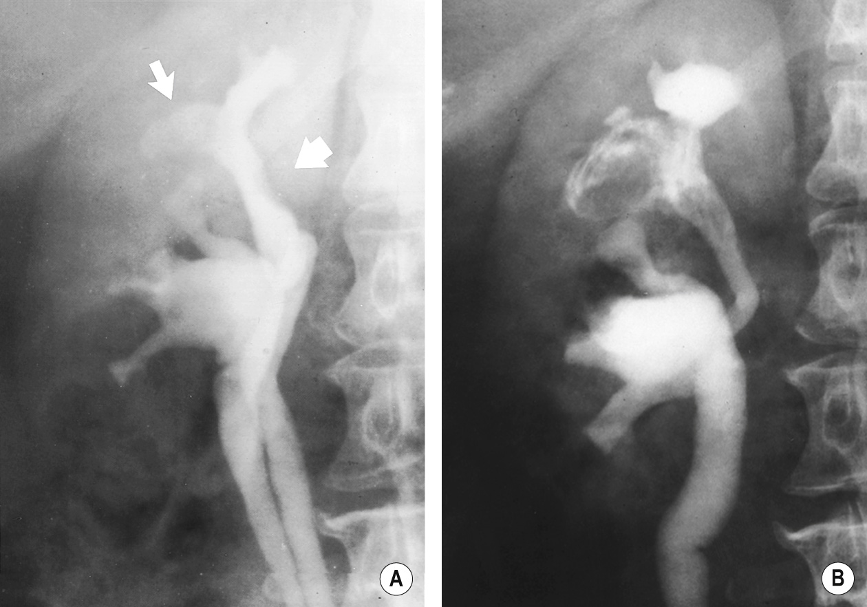 Cholesteatoma of the kidney. Recurrent urinary tract infection for many years. (A) IVU 1975. Filling defect in upper pole calyx (arrow). Also there is a flat defect in the infundibulum (broad arrow). The latter is consistent with leukoplakia. (B) IVU 1979. Extensive irregular filling defects with typical whorled pattern in the upper pole. *
